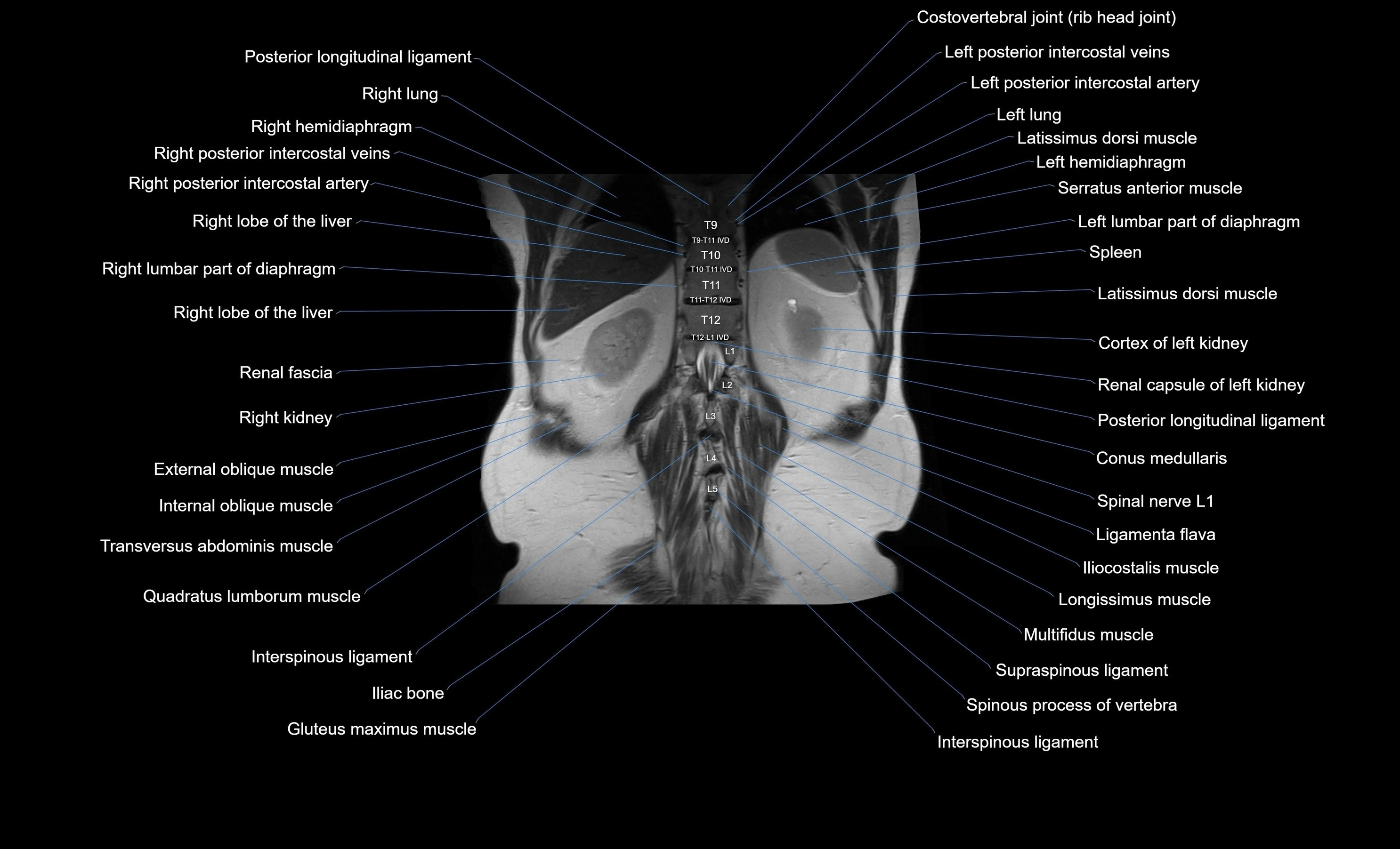 MRI Abdomen coronal labelled cross sectional anatomy radiology  image-img-00001-00047.webp